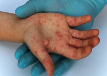 Góc giải đáp: Bệnh đậu mùa khỉ là gì, dấu hiệu nhận biết và cách điều trị ra sao?